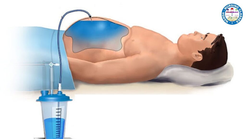 What is Paracentesis and abdominal Paracentesis? why there is need of Paracentesis ? ascitic tapping, Paracentesis Procedure, Paracentesis articles.