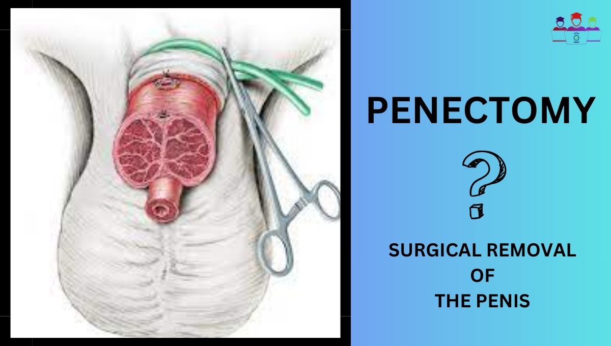 Penectomy, penectomy, penectomy procedure, partial penectomy, total penectomy, total penectomy surgery, procedure, penectomy surgery video, surgical education, radical prostatectomy survival rates, penectomy smith, surgical video, 90 days after penectomy, meatal stenosis after partial penectomy, penile cancer survival, management of meatal obstruction in a case of partial penectomy, prostatectomy (medical treatment), #partialpenectomy, radical prostatectomy side effects