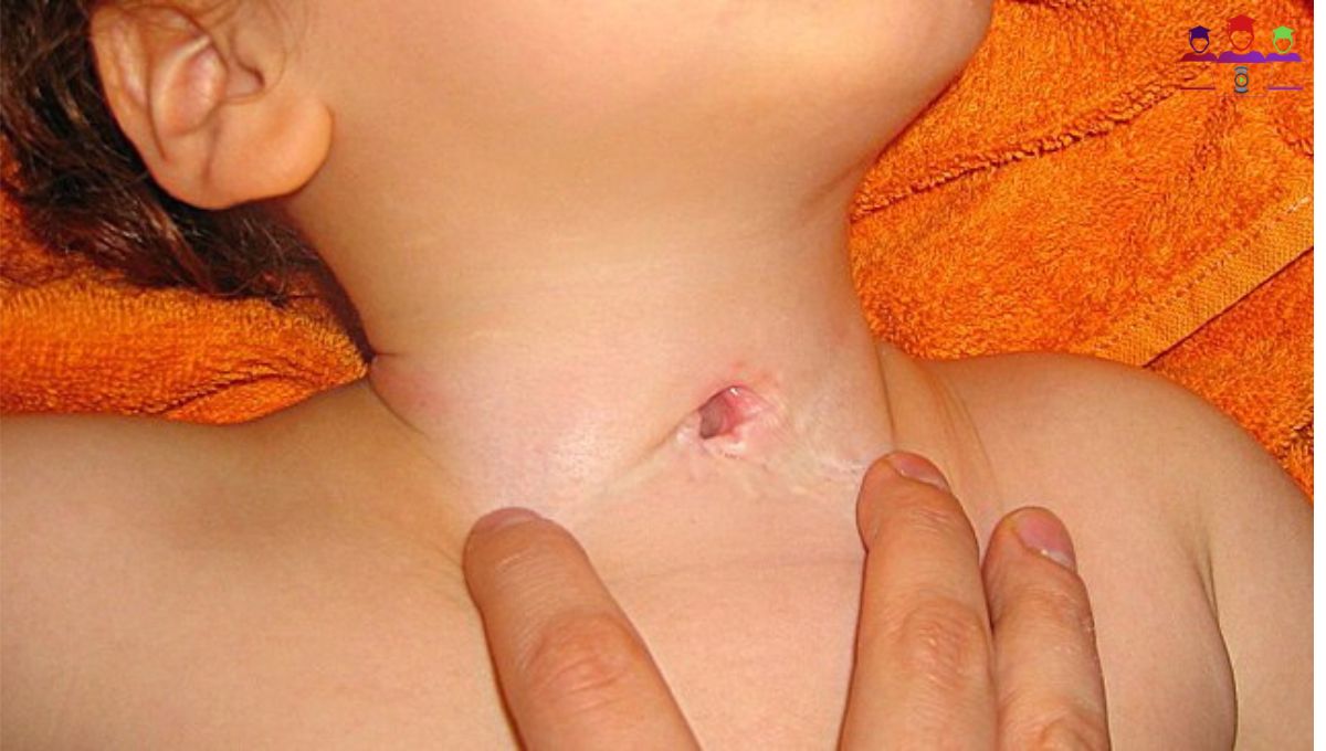 tracheostoma, tracheostomy, trachiostoma, tracheostony, tracheostomy tube, tracheostomy care, tracheostomy cuff, tracheostomy speak, tracheostomy tubes, trachestomy, tracheotomy, trachostomy, tracheostomy animation, tracheostomy lecture, tracheostomy healing, what is a tracheostomy, tracheostomy management, tracheostomy tube care, tracheostomy training, tracheostomy recovery, dilation tracheostomy, what is tracheostomy?, tracheostomy procedure, tracheostomy tube types, emergency tracheostomy