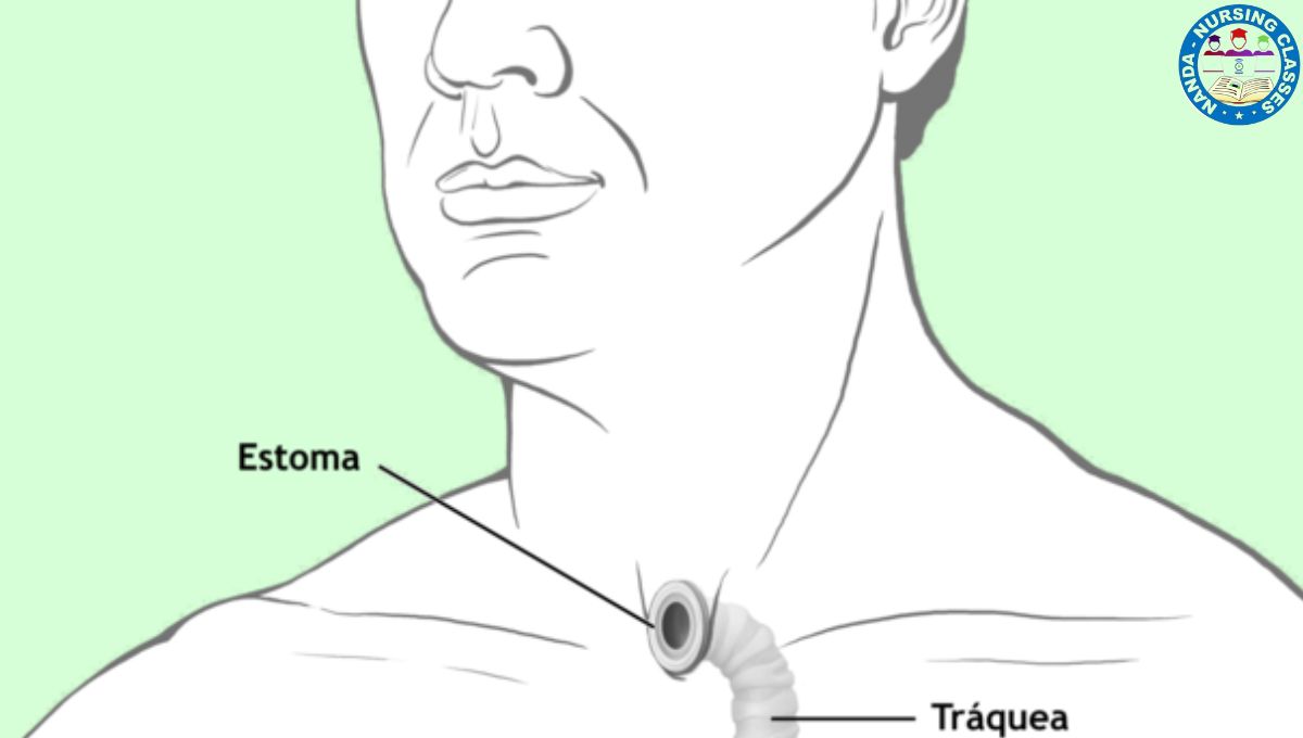 tracheostomy, tracheostomy tube, tracheostomy care, tracheostomy cuff, tracheostomy speak, tracheostomy tubes, what is tracheostomy, tracheostomy lecture, tracheostomy healing, what is a tracheostomy, tracheostomy training, tracheostomy supplies, tracheostomy recovery, surgical tracheostomy, practice tracheostomy, what is tracheostomy?, tracheostomy procedure, tracheostomy animation, tracheostomy management, tracheostomy tube change, tracheostomy suctioning, why perform tracheostomy, tracheostomy care nursing