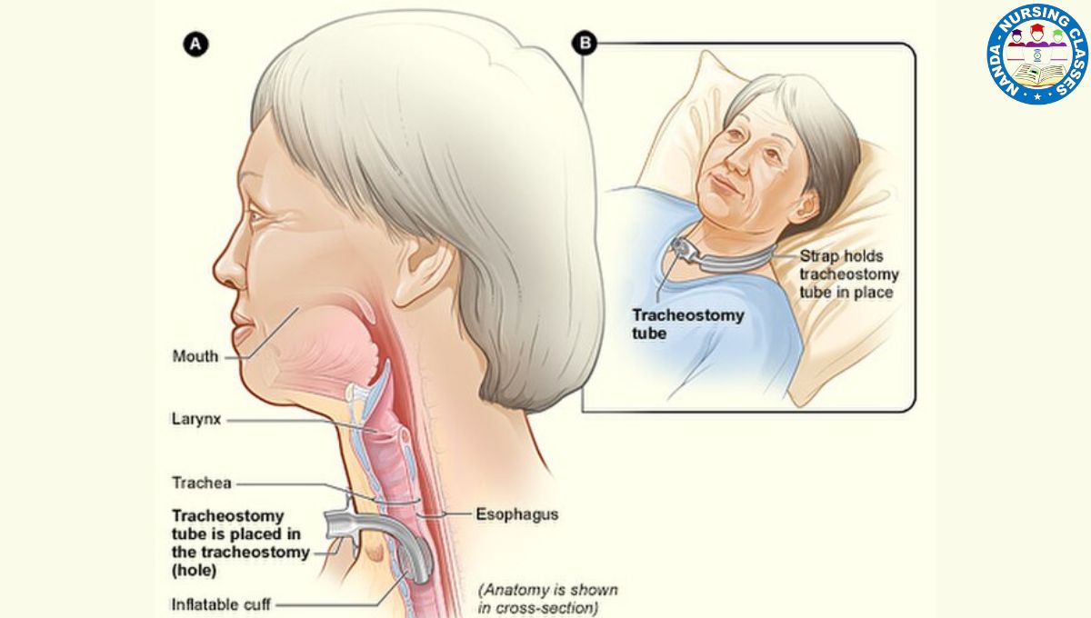 tracheostomy procedure, tracheostomy procedures steps, tracheostomy procedures explain, tracheostomy care nursing procedure, tracheostomy pre-procedure, tracheostomy, tracheostomy care, tracheostomy lecture, practice tracheostomy, tracheostomy tube, tracheostomy nursing care, tracheostomy care nursing, nursing tracheostomy care, surgical tracheostomy, tracheostomy tube care, tracheostomy speak, tracheostomy tubes, tracheostomy tube types, what is tracheostomy, tracheostomy safety, why perform tracheostomy