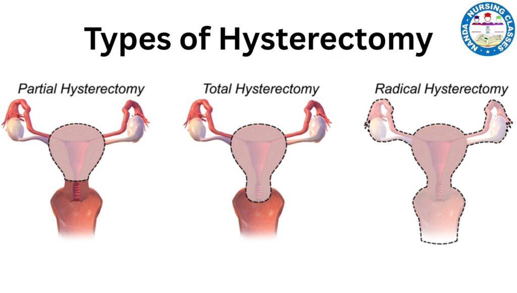What is a partial hysterectomy, types of hysterectomy, what is a hysterectomy, what is hysterectomy, partial hysterectomy, partical hysterectomy, what its like after hysterectomy, laparoscopic hysterectomy what to expect, walking after a hysterectomy, what to expect after laparoscopic hysterectomy surgery, safe exercises after a hysterectomy, recovering from a hysterectomy, total hysterectomy, hysterectomy, vaginal hysterectomy, radical hysterectomy, laparoscopic hysterectomy, abdominal hysterectomy, hysterectomy operation, robotic hysterectomy, hysterectomy pros