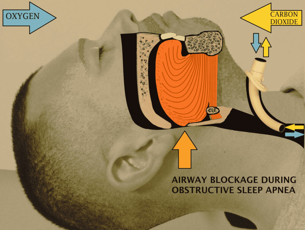 what is a tracheostomy, what is the tracheostomy